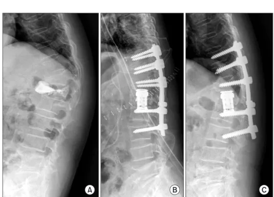 Figure 3. A 70-year-old female patient  treated without distal hook augmentation. 