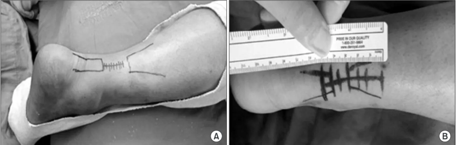 Figure 3. The paratenon and skin were closed in mini-incision percutaneous repair (A) and open repair (B)