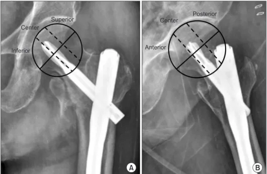 Figure 1. Determination of the quadrant  on anteroposterior view (A) and lateral  view (B).