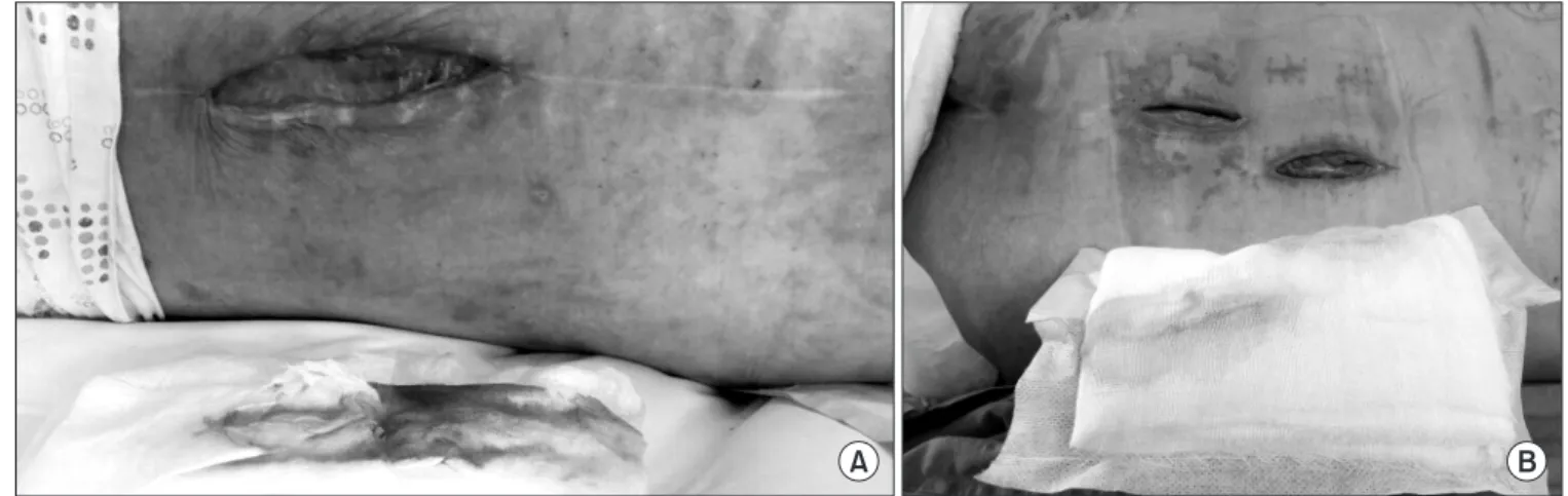 Figure 3. Red pigmentation of Serratia marcescens discharged from wound blood­red (A) compared with other usual open wounds (B)