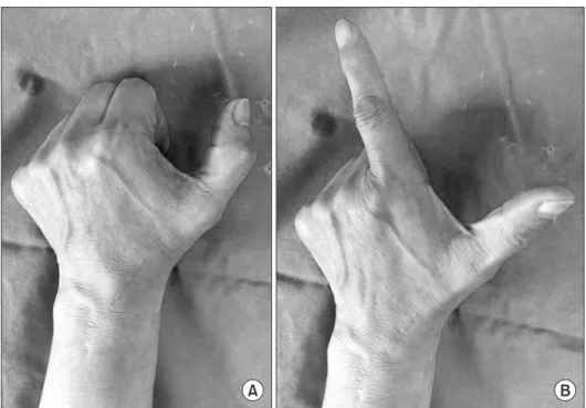 Figure 4. (A) Abnormal signs included  inability to extend the thumb when the  second finger was in flexion