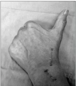 Figure 6. Last follow­up. Note: full extension and dorsal elevation of  thumb without extension of the 2nd finger