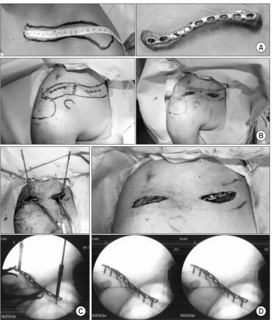 Figure 1. Operation steps of minimally  invasive plate osteosynthesis for  clavicle fracture
