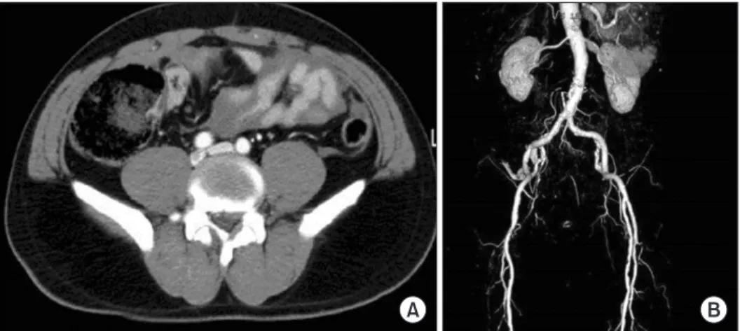Figure 3. Computed tomography (CT) (A)  and 3-dimensional CT angiography (B) do  not reveal any evidence of extravasation  and aneurysm.