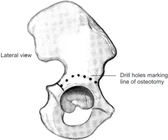 Figure 17. Ideal level of osteotomy is just above the capsular attachment  between the capsule and the reflected head of rectus femoris