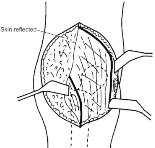 Figure 2. Approach of rotational acetabular osteotomy. This approach  combines the anterior iliofemoral and posterior approaches through a  single skin incision