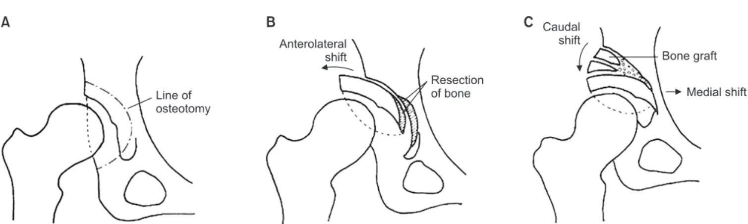Figure 4. Transpositional osteotomy. Rotation of the acetabulum is  focused on anterior rotation.
