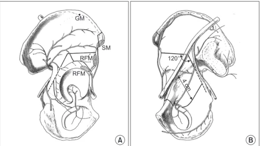 Figure 14. Bernese periacetabular os- os-teotomy. (A) External surface. (B) Internal  surface