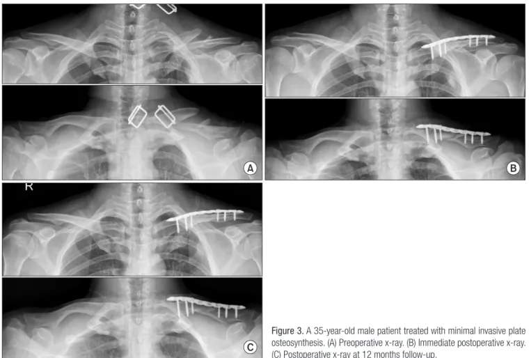 Figure 3. A 35-year-old male patient treated with minimal invasive plate  osteosynthesis