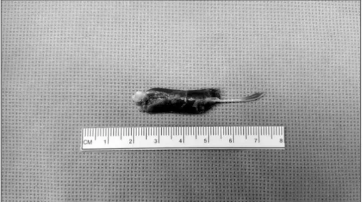 Figure 4. Excised extensor digitorum brevis manus was 6 cm.