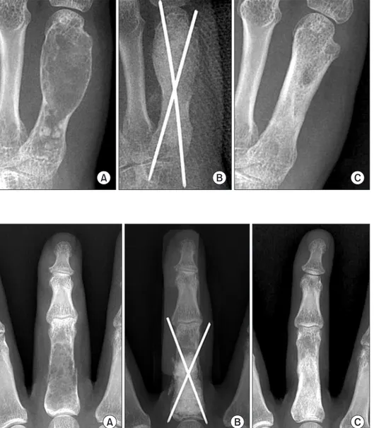 Figure 3. (A) Preoperative radiograph in  a 21-year-old female shows a lytic lesion  and intralesional calcification in association  with a pathologic fracture involving 3/4 of  the proximal phalanx of the middle finger