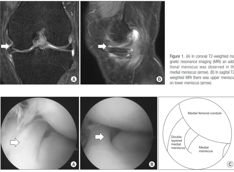 Figure 2. Arthroscopic findings. (A) An additional semicircular meniscus was observed over the normal medial meniscus (arrow)