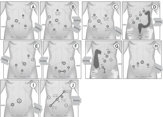 Fig. 2. Port placement for robotic total mesorectal excision (A–D) or left­sided colectomy (A, B) using the da Vinci S, Si,  or Xi system