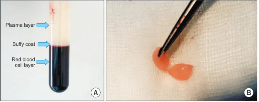 Fig. 1. (A) Three layers were seen  after first spin; plasma, buffy  coat, and red blood cells layers