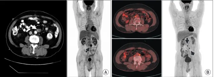 Fig. 1. (A) CT image and PET image of patient number 5 (Table 5). Short axis diameter of 17 mm, single cluster recurrent para- para-aortic lymph node (PALN) in CT image (white arrow), and correlating single high standard uptake value in PET image (black  a