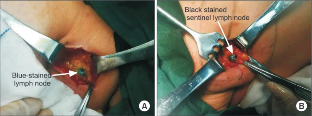 Fig. 2. Sentinel lymph node bio- bio-psy using MB and CN,  respec-tively. (A) One blue-stained  lym ph node was detected in MB  group