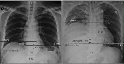 Fig. 1. Anteroposterior chest  radio graphs used for calculating  the diaphragmatic height index