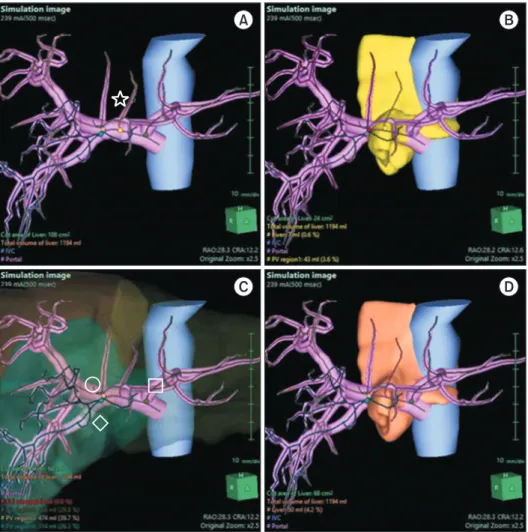 Fig. 1. The caudate parenchyma  was delineated using a  counter-staining technique. Hepatic veins,  hepatic arteries, and bile ducts  are hidden to identify images  more easily