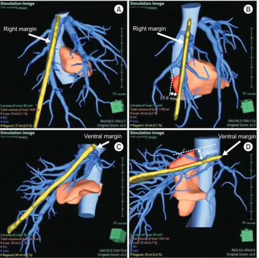 Fig. 3. Right and ventral margins  of the caudate lobe are shown. 