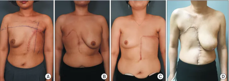 Fig. 4. Rotation-advancement flap transfer and mobilization of the tissue from the upper and lateral parts resulted in a closing  line at the center of the initial defect