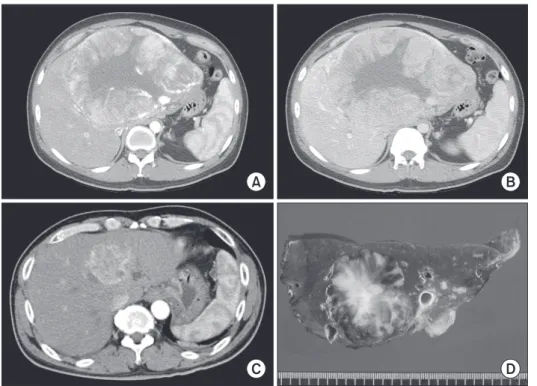 Fig. 1. CT and gross findings. 