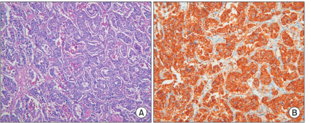Fig. 2. Microscopic examination  of a primary neuroendocrine  tumor of the liver. (A) Neoplastic  cells are arranged in combined  pat terns as trabecular  arrange-ment structures and solid nests  (H&amp;E, ×100)