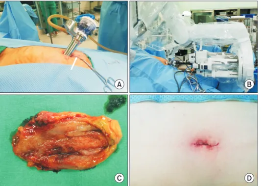 Fig. 1. Intraoperative view. Pure  single port placed through a  2.5-cm umbilical incision, for  accom-modating 4 instruments including  camera with extra orifice for assist  port