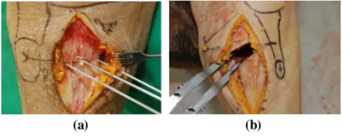 Fig. 4 (a) Three K-wires are inserted through the transverse  line according to the anteromedial surface of tibia (b)  Osteotomy gap was spread with speader