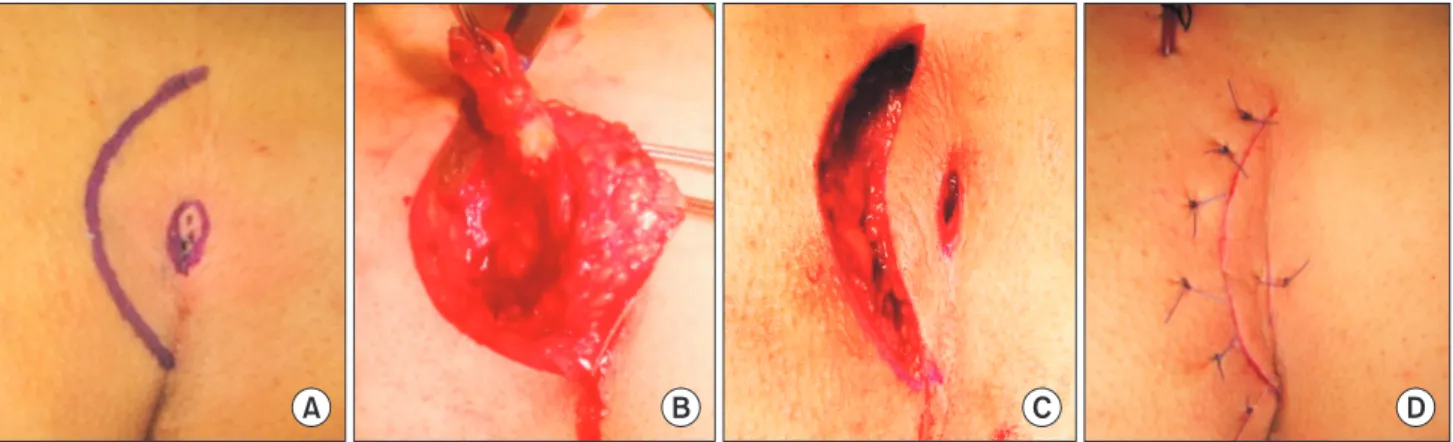Fig. 1. Excision with minimal tissue loss, closure without tension, and off-midline suture