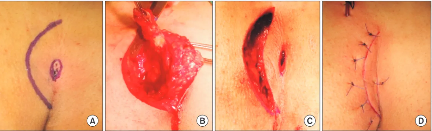 Fig. 1. Excision with minimal tissue loss, closure without tension, and off-midline suture
