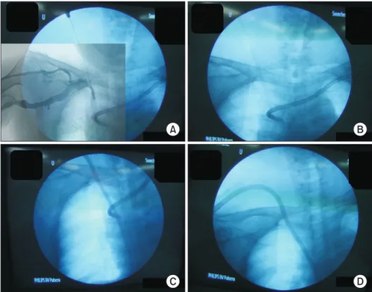 Fig. 2. (A) Garrett vascular dilator  was inserted into right inno  mi-nate vein through previously  oc-clu ded right internal jugular vein