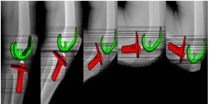 Fig. 1. Local coordinate systems of a femoral component  and a tibial component. 