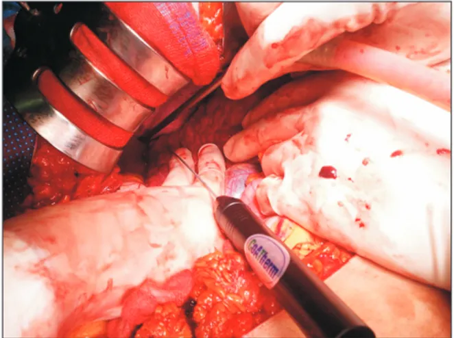 Fig. 1. Intraoperative findings of a patient who underwent  radiofrequency ablation after hematoma removal.