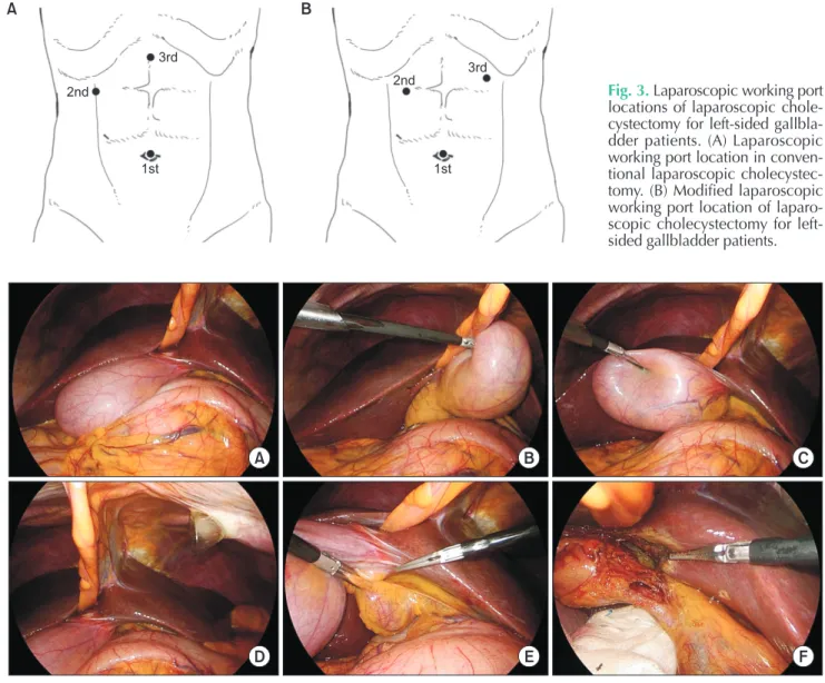 Fig. 3. Laparoscopic working port  locations of laparoscopic cho  le-cy stec tomy  for  left-sided  gal  lbla-d lbla-der  patients