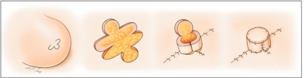 Fig. 1. Nipple reconstruction using a modified C-V flap technique. One C flap and 2 rounded V-flaps were elevated from the  reconstructed breast mound while preserving dermis and fat tissue