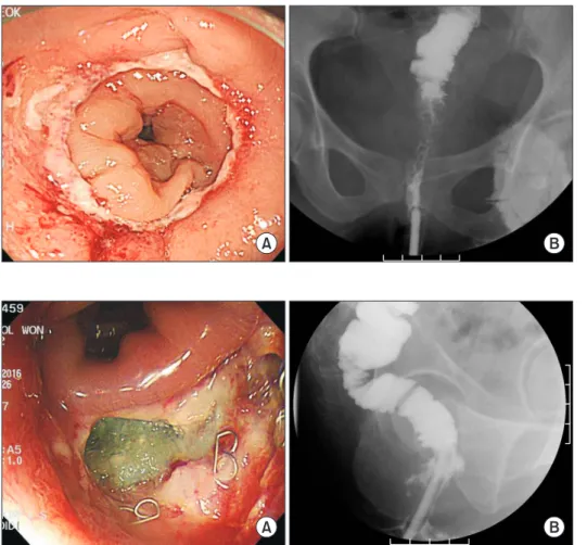 Fig. 2. Findings of intact anas- anas-tomosis: flexible sigmoscopy (A)  and proctography (B)