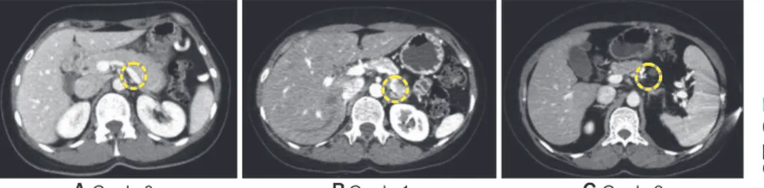 Fig. 1. Grade of vessel patency. 
