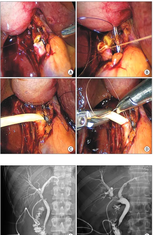 Fig. 1. View of laparoscopic  end-to-end reconstruction with  T-tube for bile duct injury during  laparoscopic: (A) step 1:  mobili-zation and clearing of both  bile duct ends, and anchoring  sutures at both corners; (B) step  2: suturing at the posterior 
