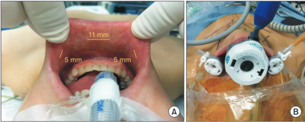 Fig. 1. Incision and trocar place- place-ment in the transoral  endo-scopic thyroidectomy vestibular  approach