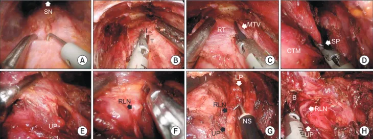 Fig. 3 shows the postoperative surgical field after right thyroid  lobectomy. The resected thyroid and central nodes were  extracted through the 11-mm port within a laparoscopic bag