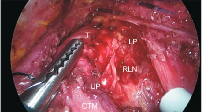 Fig. 3. Postoperative surgical field after right lobectomy. T,  trachea; CTM, cricothyroid muscle; UP, upper parathyroid; 
