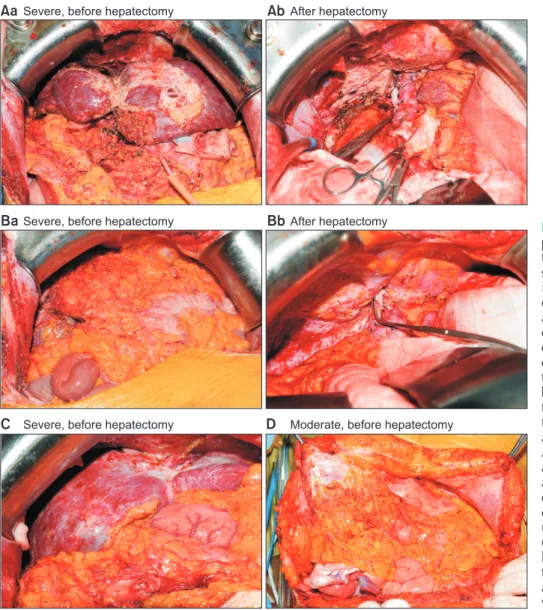 Fig. 2. (Aa) A 51-year-old male  patient had severe adhesion of  the omentum on the anterior liver  surface