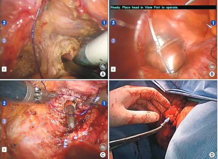 Fig. 1. A Natural Orifice Specimen Extraction (NOSE) approach for rectal cancer. (A) The rectum distal to the tumor was  divided using monopolar cautery