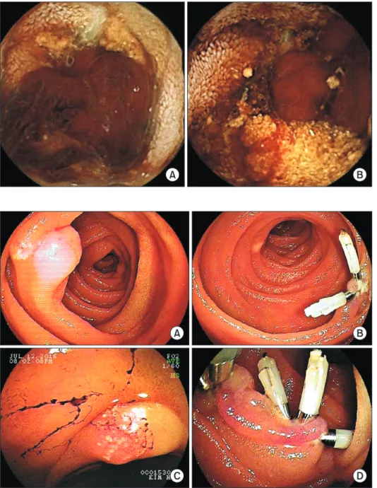 Fig. 1. Video capsule endoscopy  revealed mucosal erosion (A) with  blood clot at jejunum (B) (at about  60 cm distal to the ligament of  Treitz).