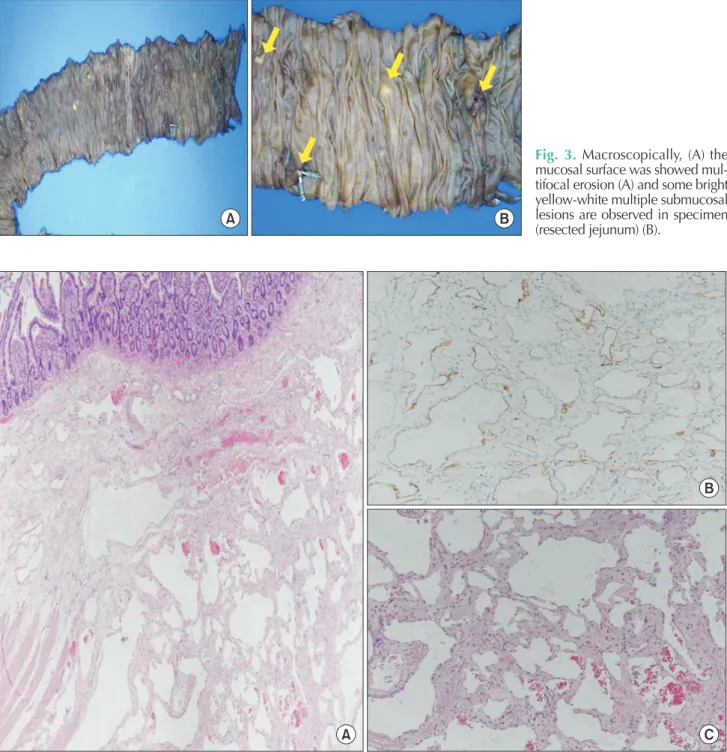 Fig. 3. Macroscopically, (A) the  mucosal surface was showed  mul-tifocal erosion (A) and some bright  yellow-white multiple sub mucosal  lesions are observed in specimen  (resected jejunum) (B).