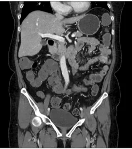 Fig. 1. Abdominal CT shown persistent short segmental  bowel wall thickening in the distal jejunum (left upper  quadrant of the abdomen).