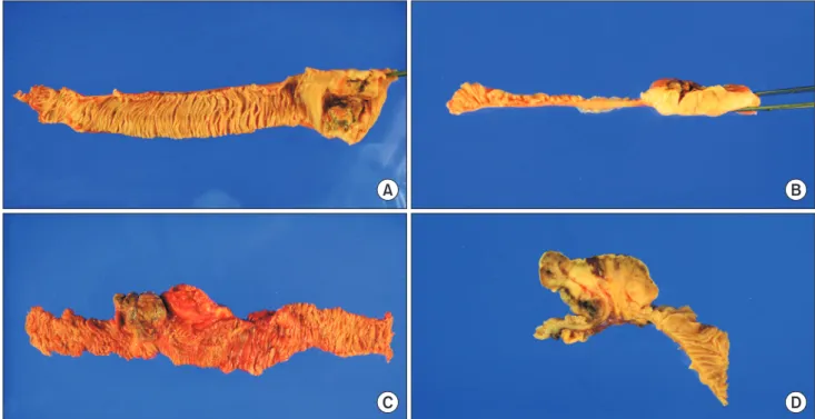 Fig. 1. Surgical specimen (A, case 1; C, case 2) and macroscopic image of the tumor cut in half (B, case 1; D, case 2)