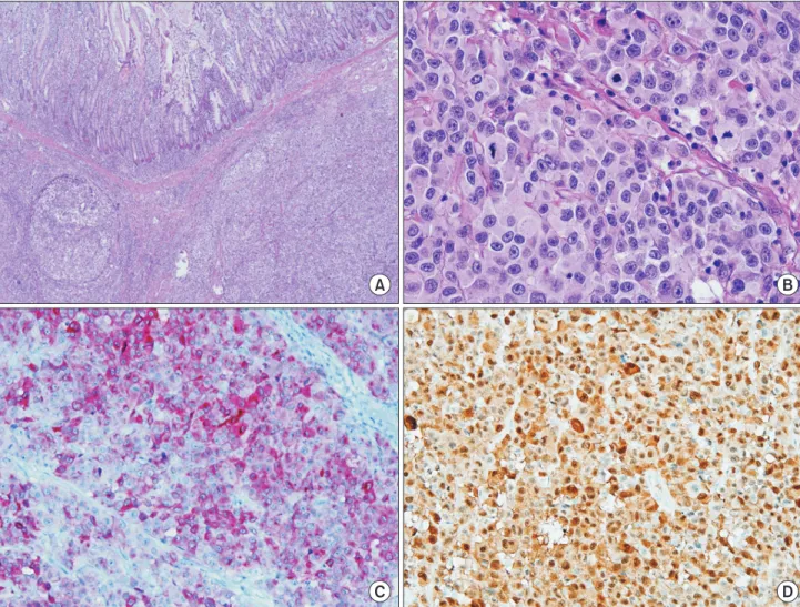 Fig. 2. Histologic feature of malignant melanoma. (A) The lesion shows diffuse atypical cells infiltration forming solid sheet (H&amp;E, 