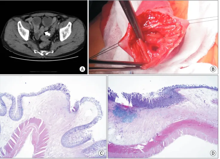 Fig. 3. (A) Abdominal CT scan showed thickening of bowel wall (white arrow) in the middle or distal segment of the ileum