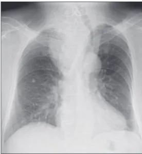 Fig. 2. Axial and coronal view of the mass showing heterogeneous enhancement with displacing trachea to left side and  compression to lumen on contrast­enhanced CT (CECT) scan